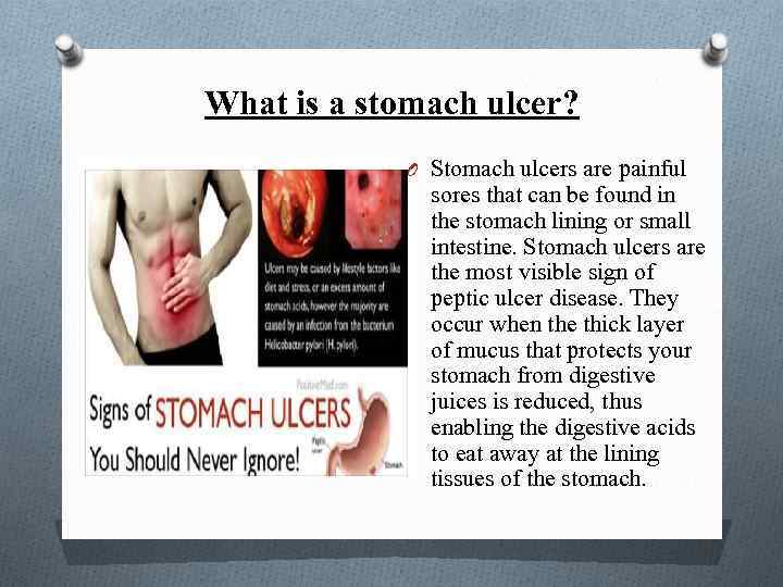 What is a stomach ulcer? O Stomach ulcers are painful sores that can be