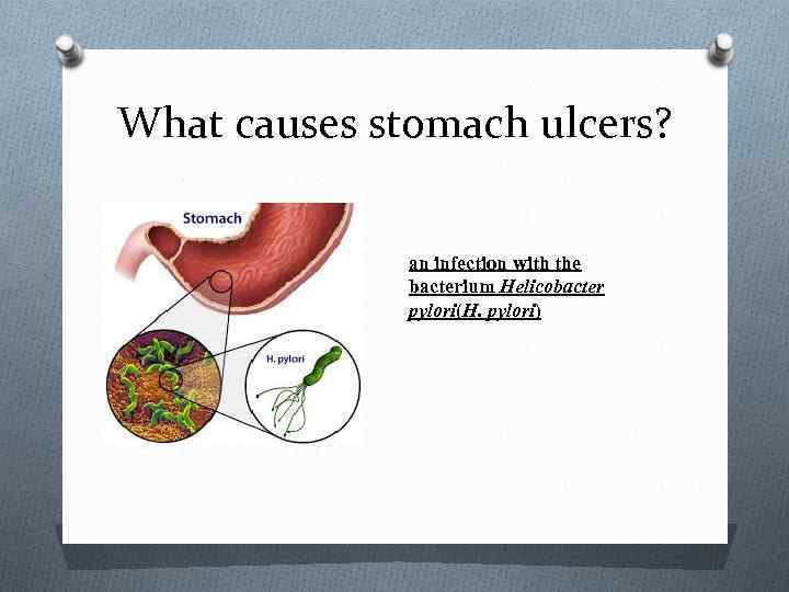 What causes stomach ulcers? an infection with the bacterium Helicobacter pylori(H. pylori) 