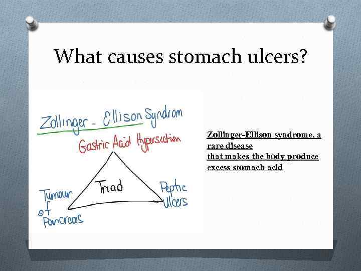 What causes stomach ulcers? Zollinger-Ellison syndrome, a rare disease that makes the body produce