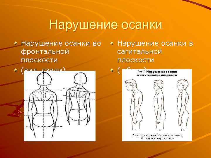 Нарушение осанки во фронтальной плоскости (вид сзади) Нарушение осанки в сагитальной плоскости ( сбоку)