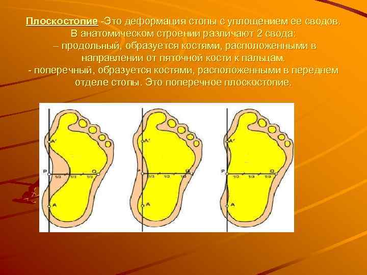 Плоскостопие -Это деформация стопы с уплощением ее сводов. В анатомическом строении различают 2 свода: