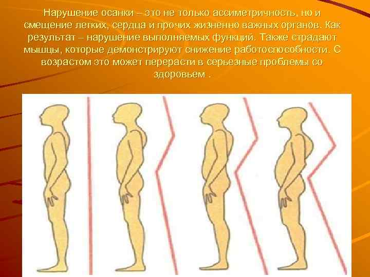 Перечислите нарушения осанки. Осанка нарушение осанки плоскостопие.