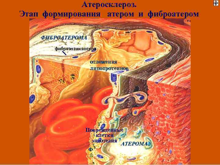 Атеросклероз. Этап формирования атером и фиброатером ФИБРОАТЕРОМА фибрознаякапсула отложения липопротеинов Поврежденные клетки эндотелия АТЕРОМА