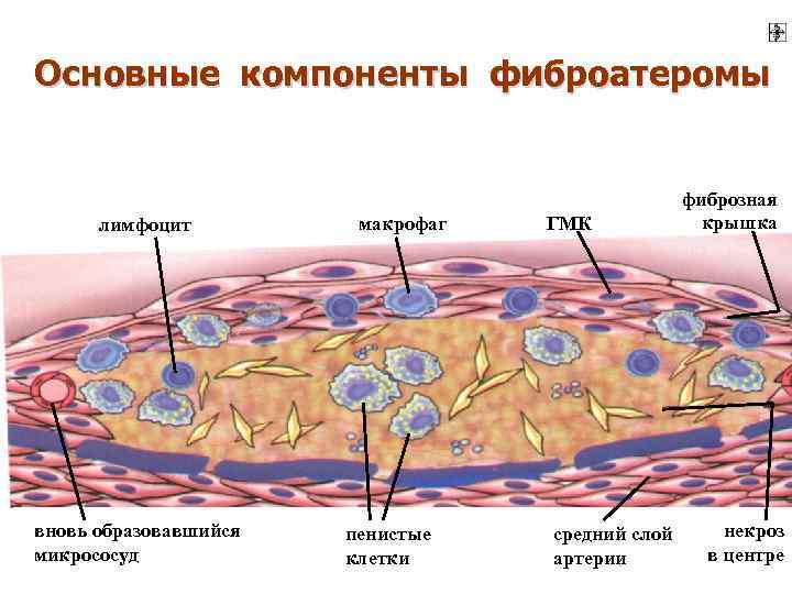 Основные компоненты фиброатеромы лимфоцит вновь образовавшийся микрососуд макрофаг пенистые клетки ГМК средний слой артерии