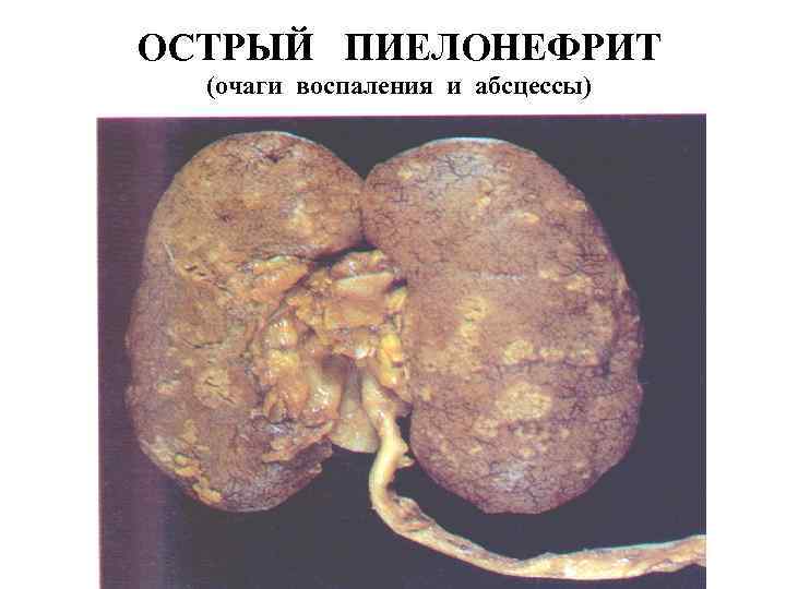 ОСТРЫЙ ПИЕЛОНЕФРИТ (очаги воспаления и абсцессы) 