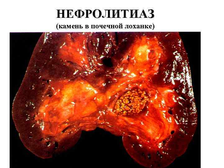 НЕФРОЛИТИАЗ (камень в почечной лоханке) 