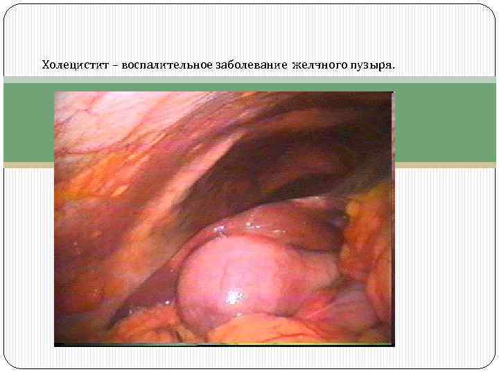 Холецистит – воспалительное заболевание желчного пузыря. 