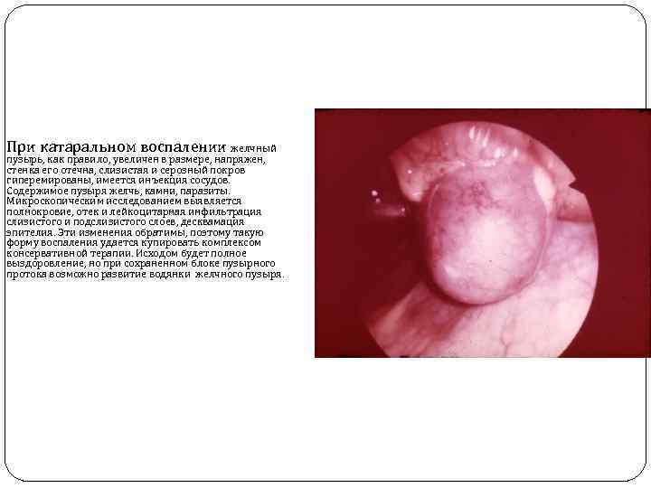 При катаральном воспалении желчный пузырь, как правило, увеличен в размере, напряжен, стенка его отечна,