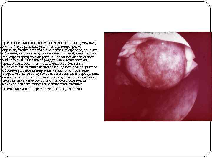 При флегмонозном холецистите (гнойном) желчный пузырь также увеличен в размере, резко напряжен, стенка его