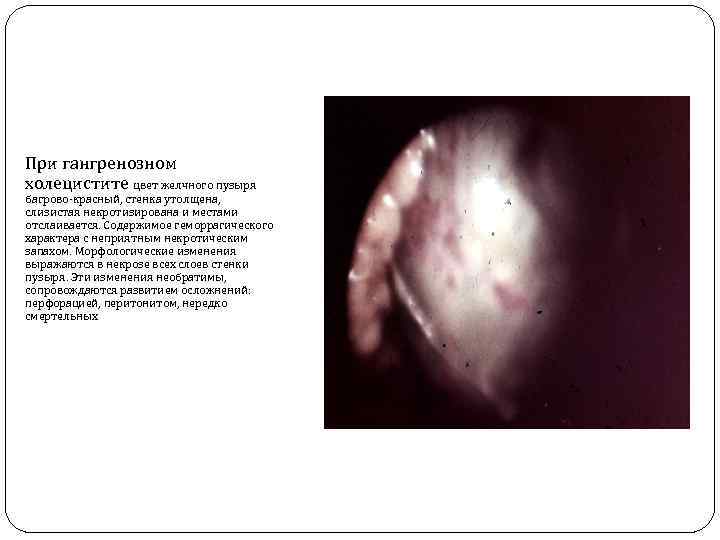 При гангренозном холецистите цвет желчного пузыря багрово-красный, стенка утолщена, слизистая некротизирована и местами отслаивается.