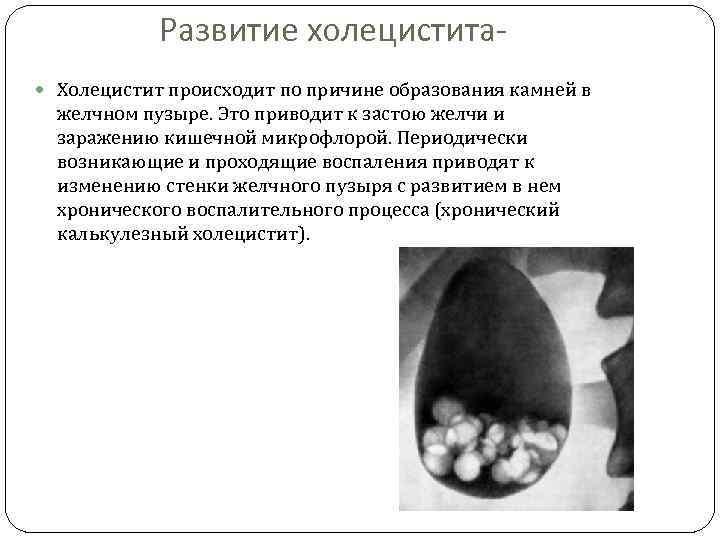 Развитие холецистита Холецистит происходит по причине образования камней в желчном пузыре. Это приводит к