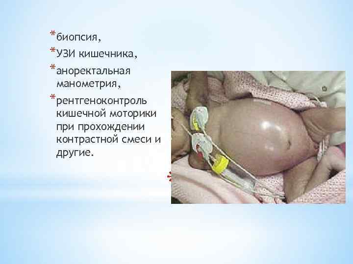 *биопсия, *УЗИ кишечника, *аноректальная манометрия, *рентгеноконтроль кишечной моторики прохождении контрастной смеси и другие. *