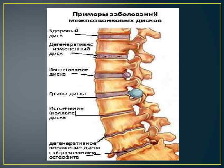 Остеохондроз позвоночника фото