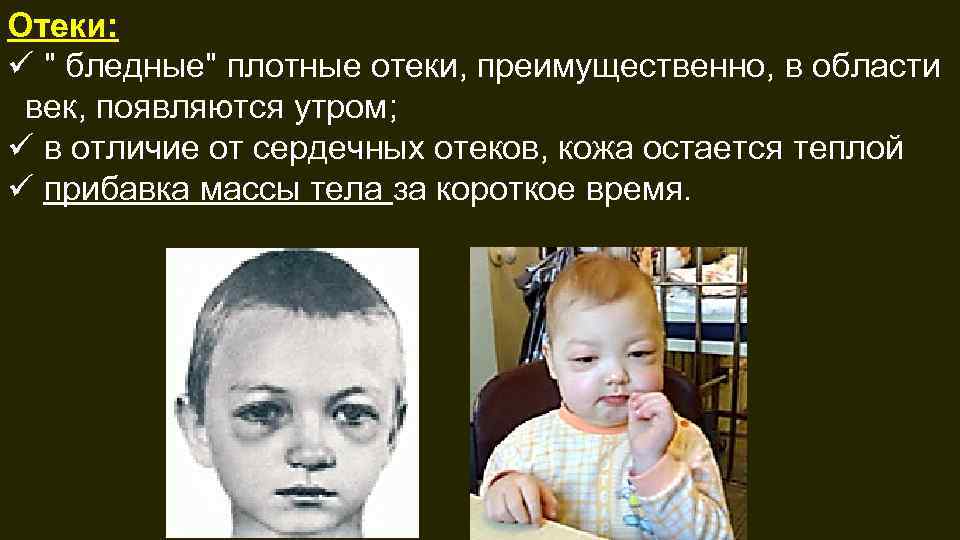 Отеки: ü " бледные" плотные отеки, преимущественно, в области век, появляются утром; ü в