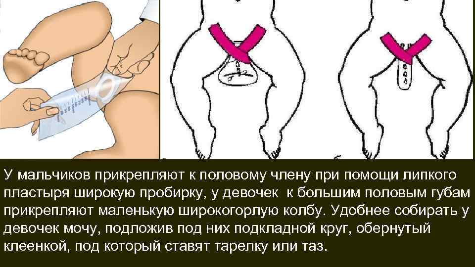 У мальчиков прикрепляют к половому члену при помощи липкого пластыря широкую пробирку, у девочек