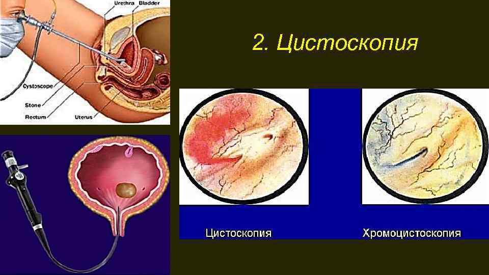 2. Цистоскопия 