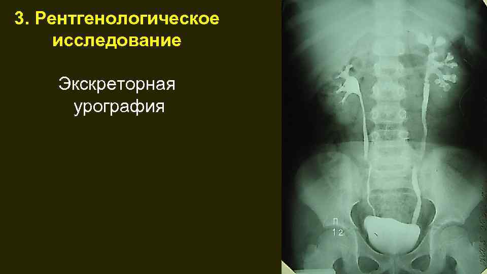 На качестве изображения мочевых путей при экскреторной урографии отражается