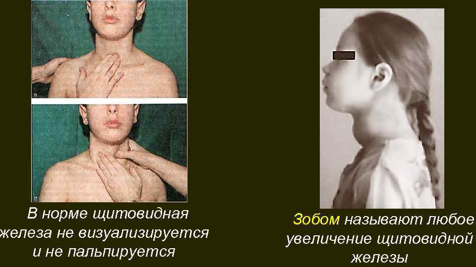 В норме щитовидная железа не визуализируется и не пальпируется Зобом называют любое увеличение щитовидной