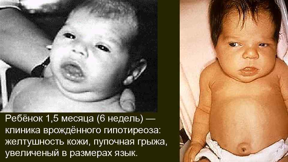 Ребёнок 1, 5 месяца (6 недель) — клиника врождённого гипотиреоза: желтушность кожи, пупочная грыжа,