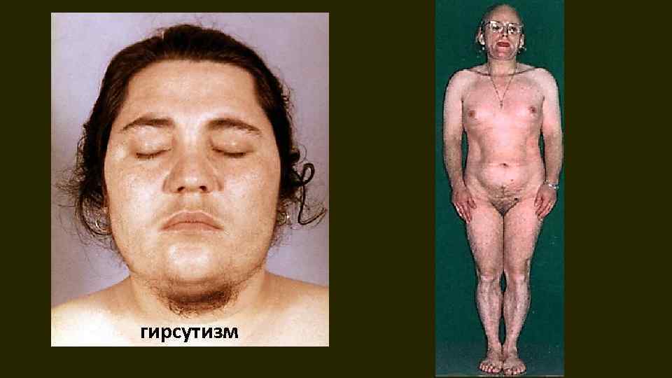 гирсутизм 