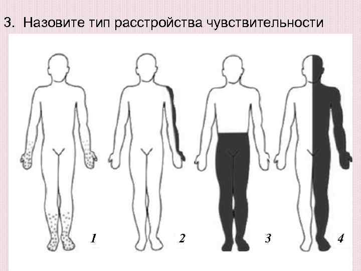 Типы расстройств. Назовите Тип расстройства чувствительности. Нарушение чувствительности по типу перчаток. Расстройство чувствительности по типу перчаток и носков. Мозаический Тип расстройства чувствительности.