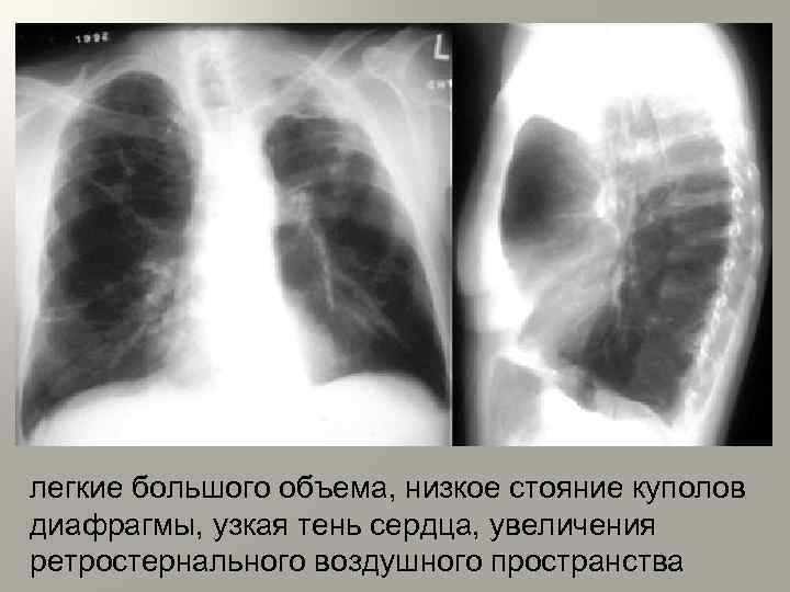 легкие большого объема, низкое стояние куполов диафрагмы, узкая тень сердца, увеличения ретростернального воздушного пространства