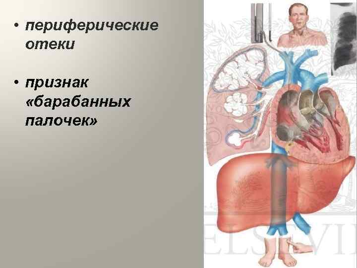  • периферические отеки • признак «барабанных палочек» 