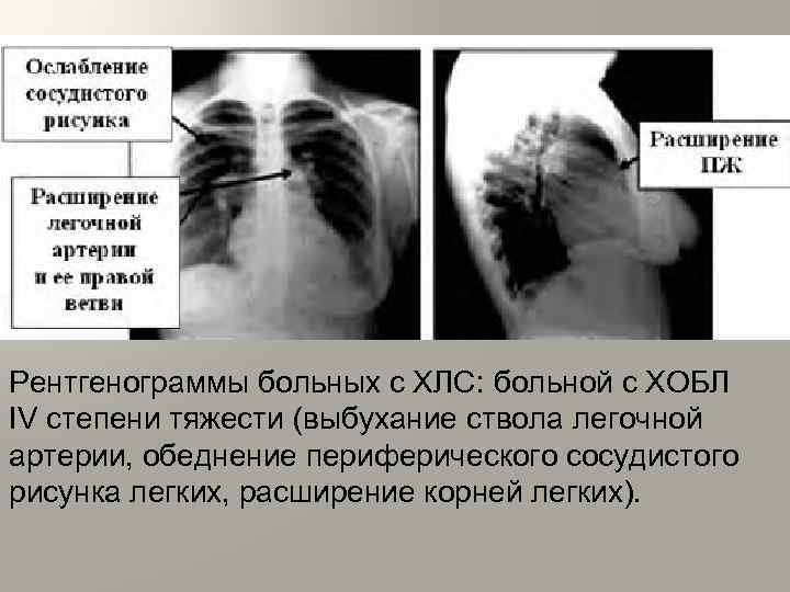 Рентгенограммы больных с ХЛС: больной с ХОБЛ IV степени тяжести (выбухание ствола легочной артерии,