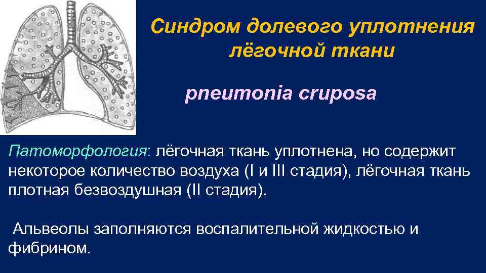 Синдром долевого уплотнения лёгочной ткани pneumonia cruposa Патоморфология: лёгочная ткань уплотнена, но содержит некоторое