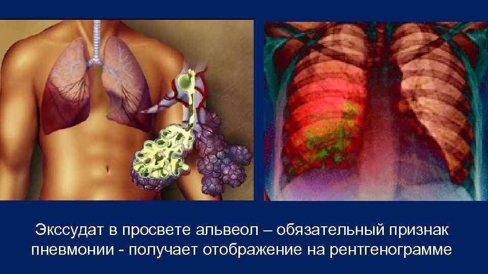 Экссудат в просвете альвеол – обязательный признак пневмонии получает отображение на рентгенограмме 