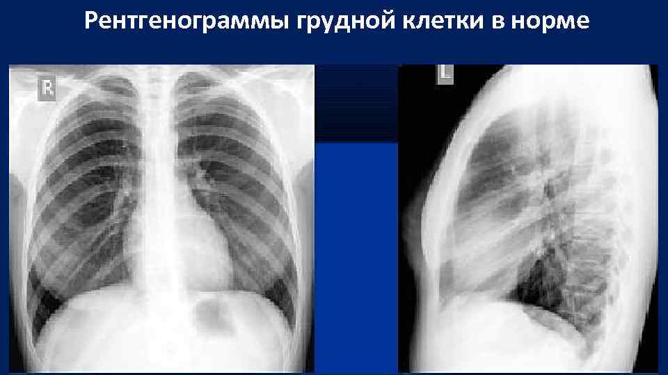 Рентген грудной клетки фото здорового человека