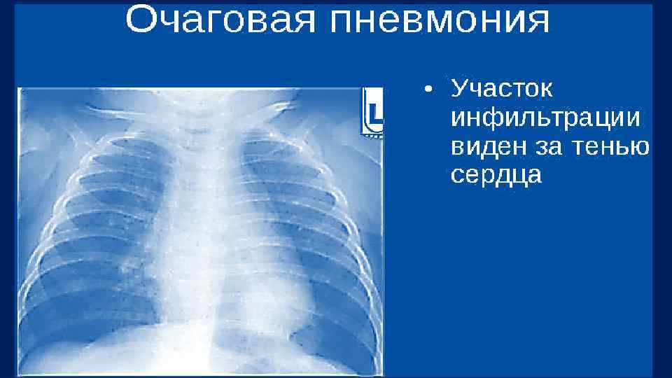 Внегоспитальная пневмония карта вызова