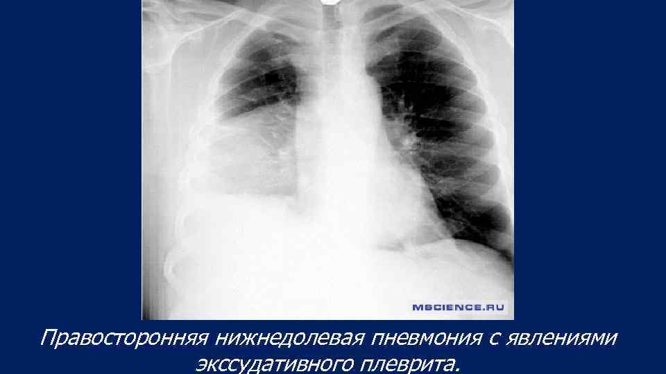 Пневмония в правом легком в нижней доле. Внебольничная пневмония осложненная экссудативным плевритом. Пневмония осложненная плевритом рентген. Нижнедолевая пневмония с плевритом. Нижнедолевая пневмония рентген.