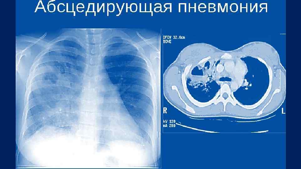 Клиническая картина пневмонии