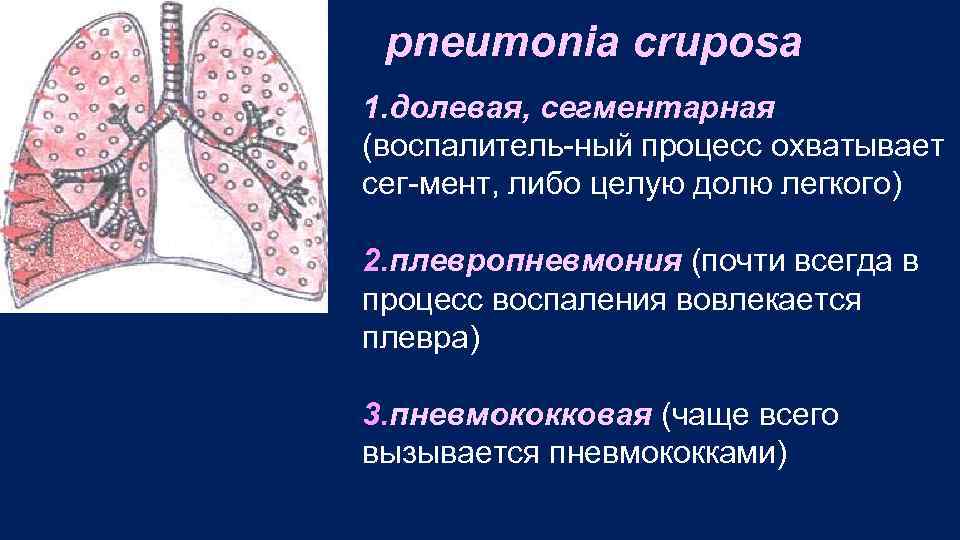 pneumonia cruposa 1. долевая, сегментарная (воспалитель ный процесс охватывает сег мент, либо целую долю