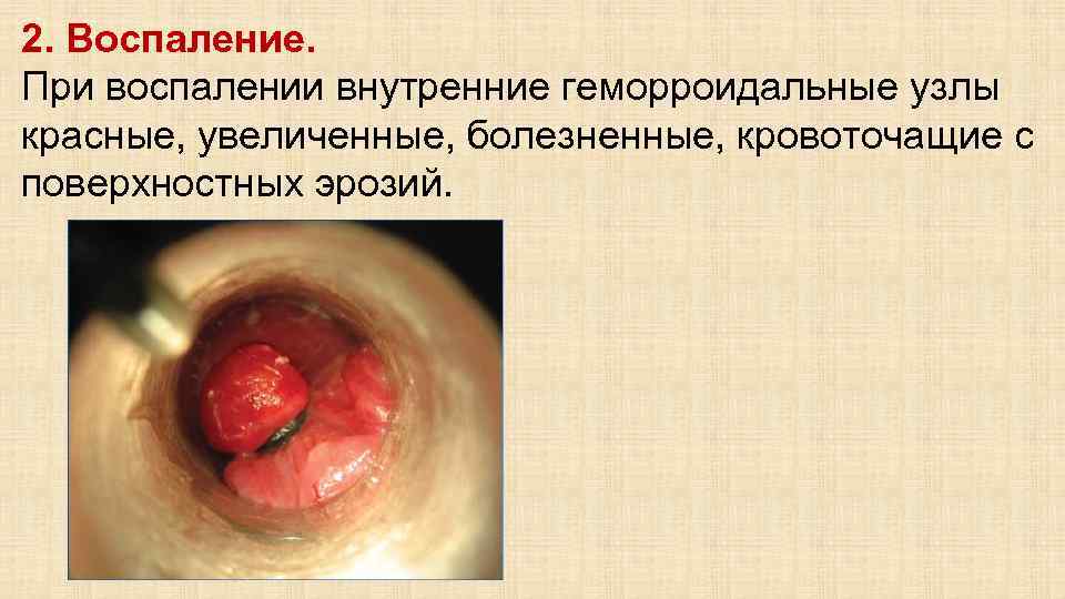 2. Воспаление. При воспалении внутренние геморроидальные узлы красные, увеличенные, болезненные, кровоточащие с поверхностных эрозий.