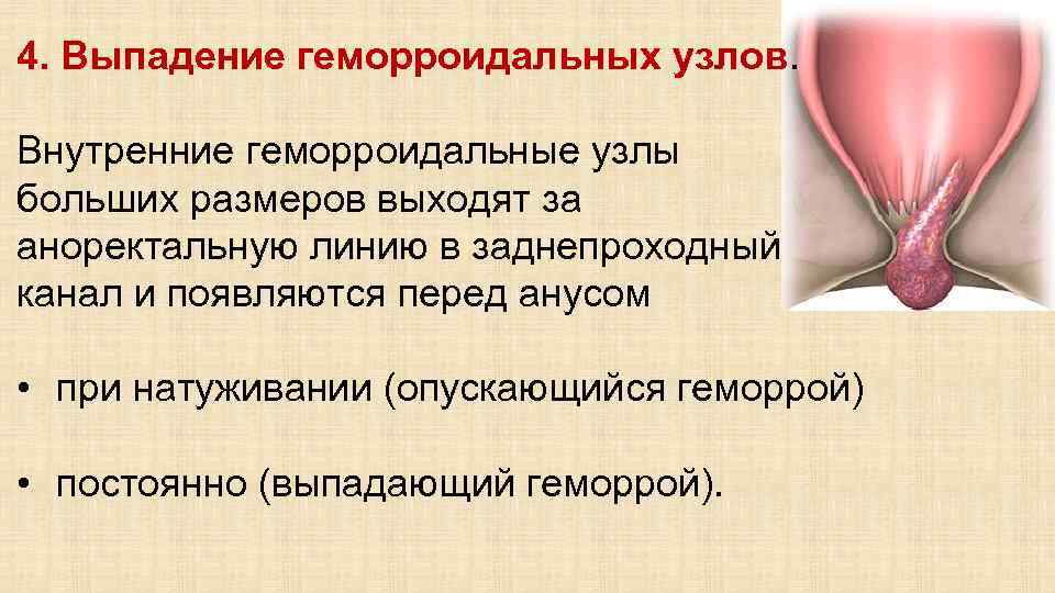 4. Выпадение геморроидальных узлов. Внутренние геморроидальные узлы больших размеров выходят за аноректальную линию в