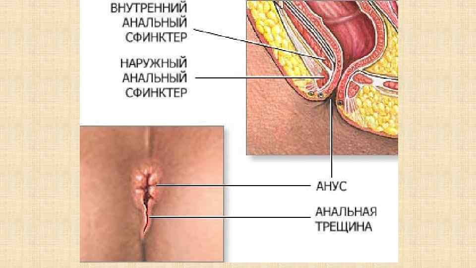 Анальный Секс Трещины