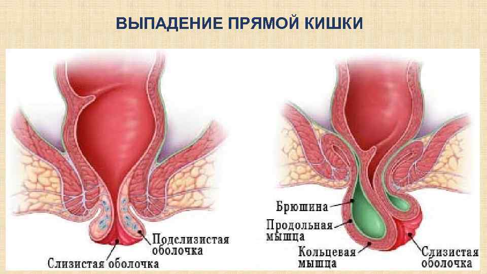 ВЫПАДЕНИЕ ПРЯМОЙ КИШКИ 