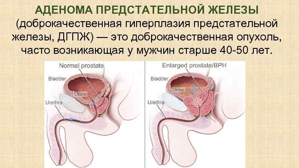 АДЕНОМА ПРЕДСТАТЕЛЬНОЙ ЖЕЛЕЗЫ (доброкачественная гиперплазия предстательной железы, ДГПЖ) — это доброкачественная опухоль, часто возникающая