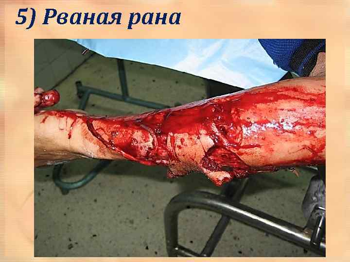 5) Рваная рана 