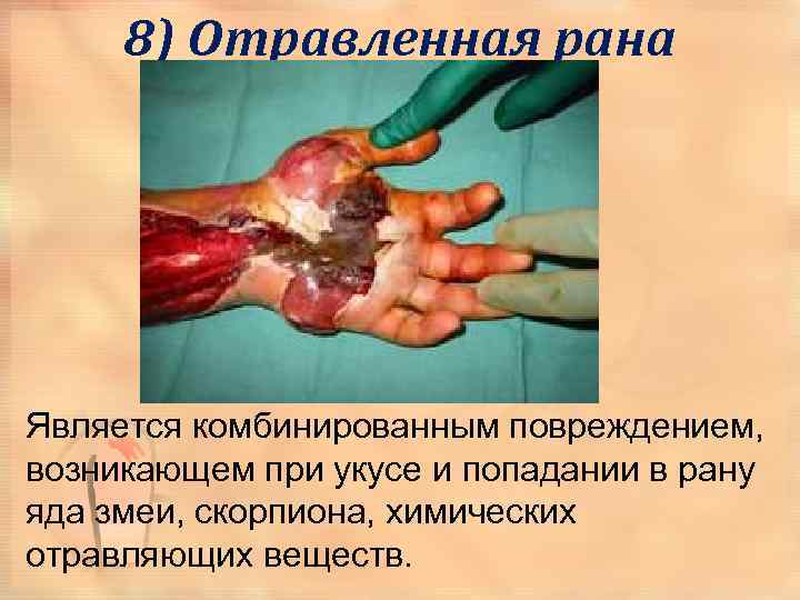 8) Отравленная рана Является комбинированным повреждением, возникающем при укусе и попадании в рану яда