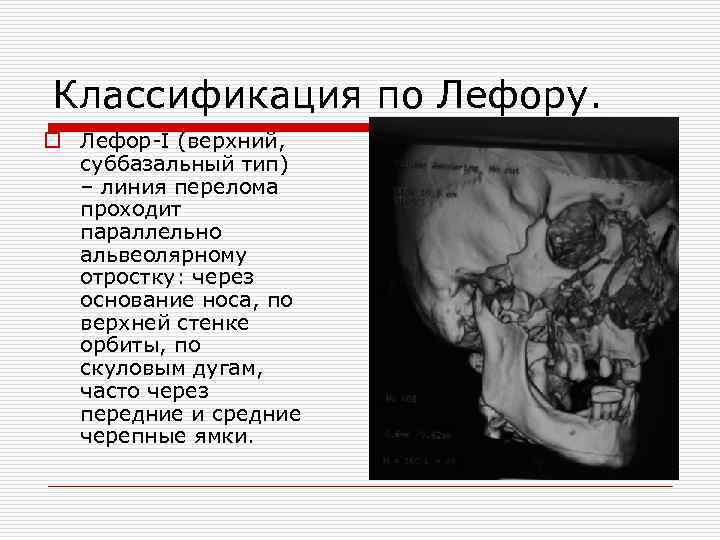 Классификация по Лефору. o Лефор-I (верхний, суббазальный тип) – линия перелома проходит параллельно альвеолярному