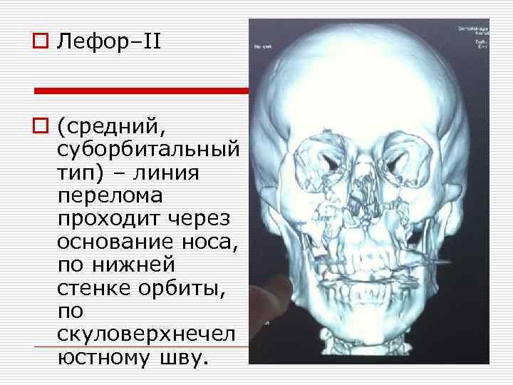 o Лефор–II o (средний, суборбитальный тип) – линия перелома проходит через основание носа, по