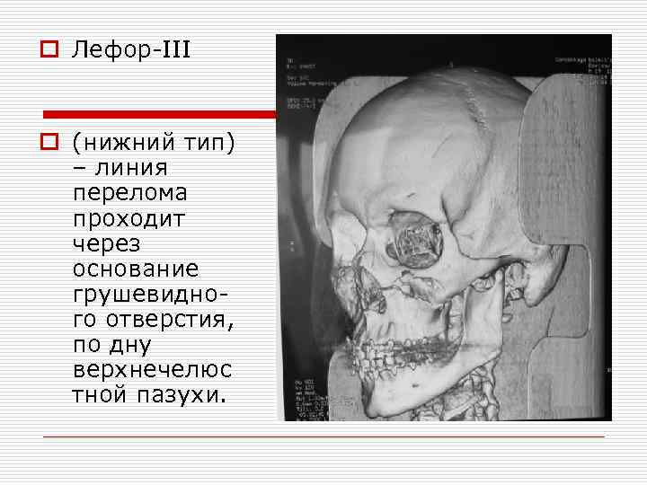 o Лефор-III o (нижний тип) – линия перелома проходит через основание грушевидного отверстия, по