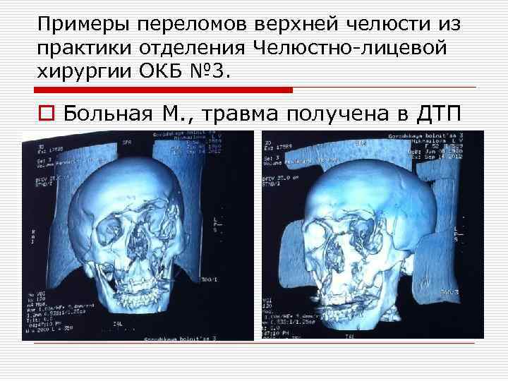 Примеры переломов верхней челюсти из практики отделения Челюстно-лицевой хирургии ОКБ № 3. o Больная