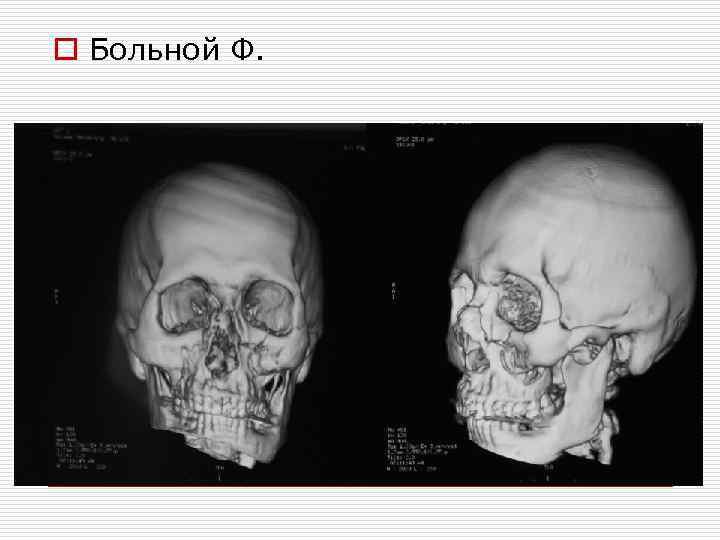 o Больной Ф. 