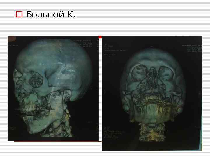 o Больной К. 