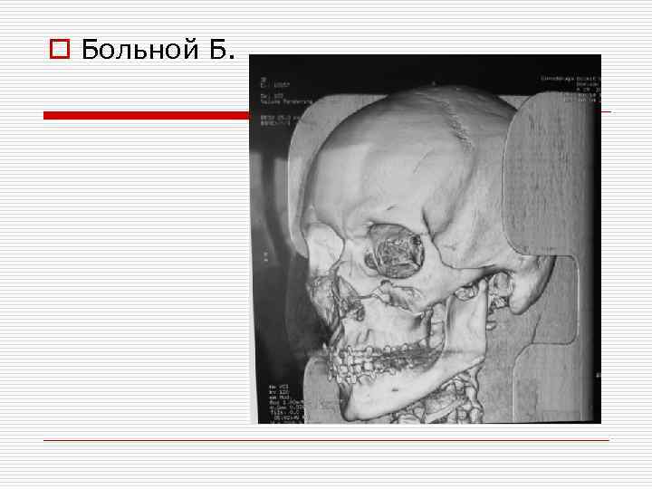 o Больной Б. 