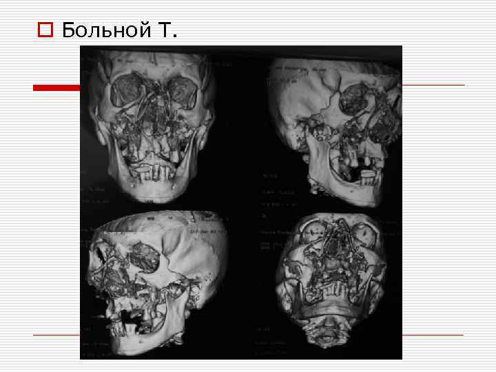 o Больной Т. 